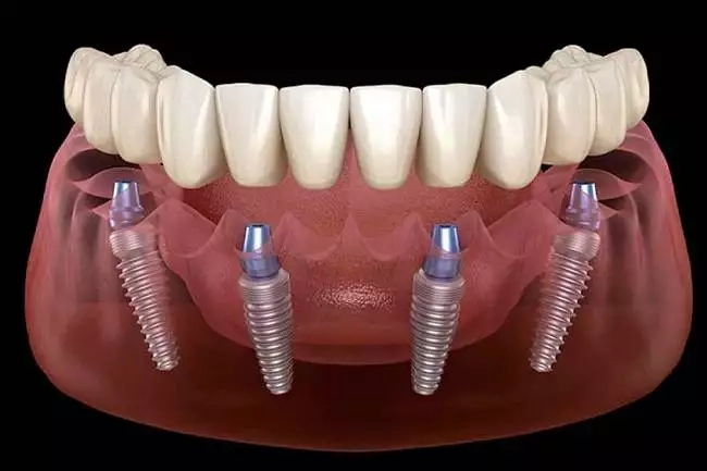 servizio implantologia a carico immediato