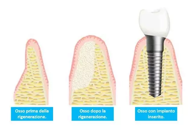 Rigenerazione Ossea